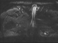 Adenocarcioma of rectum- T1 lesion (Radiopaedia 36921-38546 Axial DWI 1).png