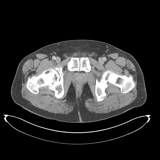 Adenocarcioma of rectum- T1 lesion (Radiopaedia 36921-38547 Axial C+ portal venous phase 89).png