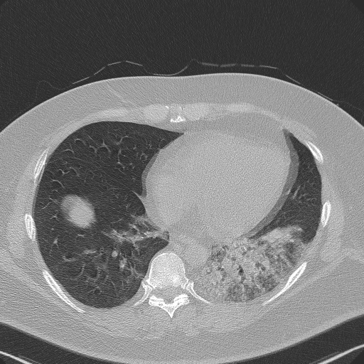 Adenoid cystic carcinoma of the trachea (Radiopaedia 49042-54137 Axial lung window 240).jpg