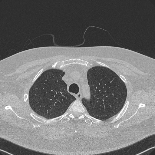 Adenoid cystic carcinoma of the trachea (Radiopaedia 49042-54137 Axial lung window 80).jpg