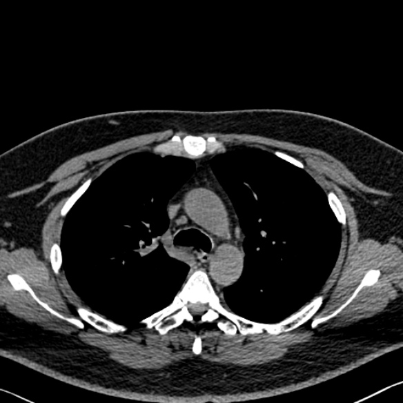 Adenoid cystic carcinoma of the trachea (Radiopaedia 49042-54137 Axial non-contrast 111).jpg