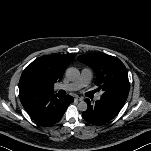 Adenoid cystic carcinoma of the trachea (Radiopaedia 49042-54137 Axial non-contrast 159).jpg