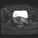 File:Adenomyosis and endometriotic cysts (Radiopaedia 82300-96367 Axial DWI 5).jpg