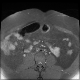 File:Adenomyosis within a didelphys uterus (Radiopaedia 70175-80215 Axial T1 C+ fat sat 5).jpg