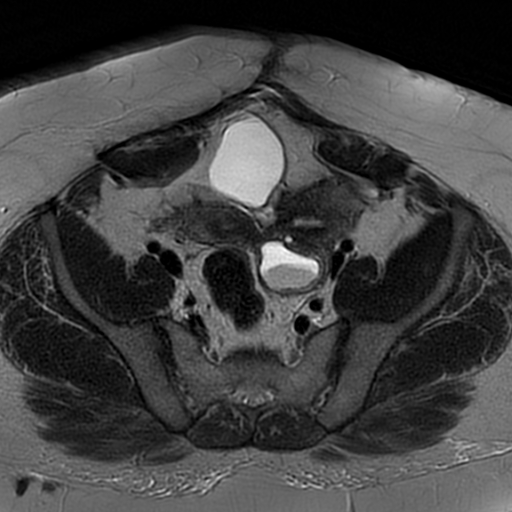 File:Adenomyosis within a didelphys uterus (Radiopaedia 70175-80215 Axial T2 13).jpg