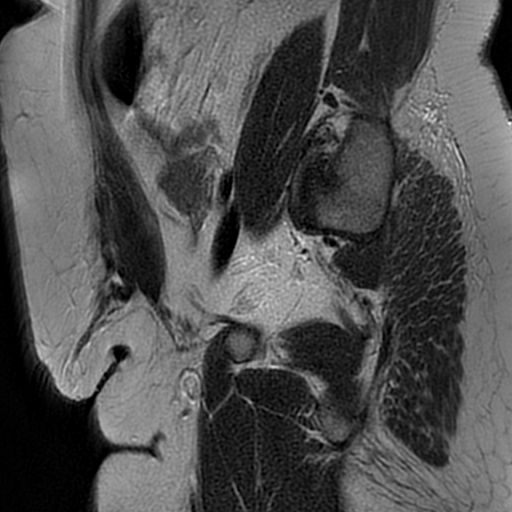 File:Adenomyosis within a didelphys uterus (Radiopaedia 70175-80215 Sagittal T2 7).jpg
