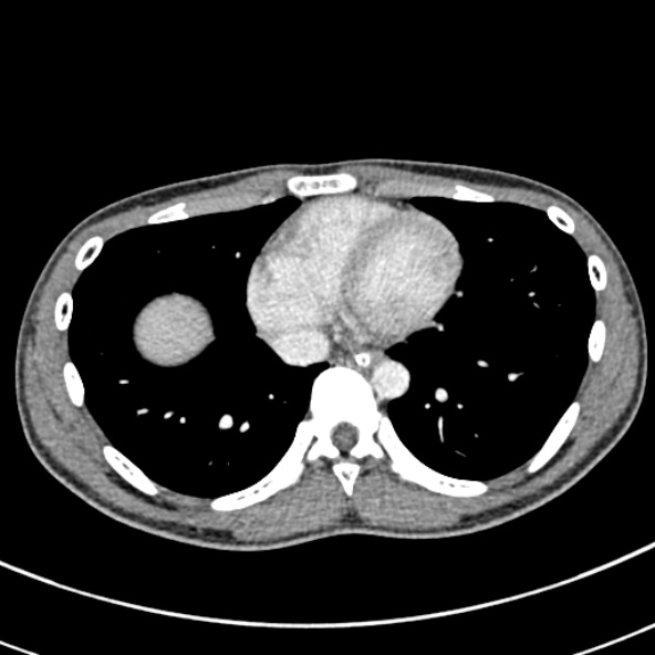 Adhesional small bowel obstruction (Radiopaedia 52107-57980 Axial C+ portal venous phase 1).jpg