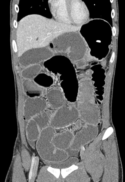 Adhesional small bowel obstruction (Radiopaedia 52107-57980 Coronal C+ portal venous phase 23).jpg