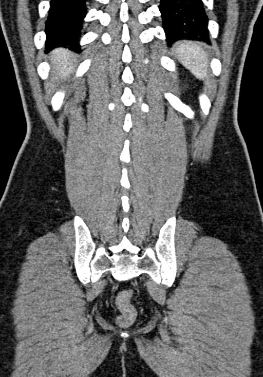 Adhesional small bowel obstruction (Radiopaedia 58900-66131 Coronal C+ portal venous phase 207).jpg