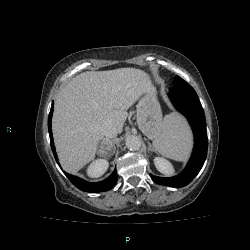 File:Adrenal collision tumor (ACT) (Radiopaedia 48462-53379 Axial C+ delayed 13).jpg