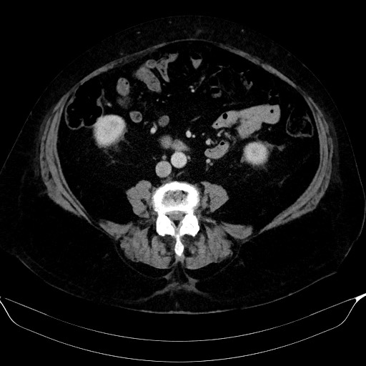 Adrenal cortical carcinoma (Radiopaedia 64017-72769 Axial C+ portal venous phase 40).jpg
