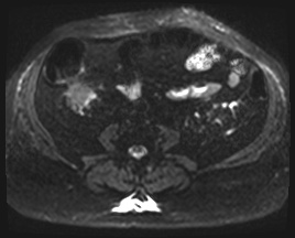 Adrenal cortical carcinoma (Radiopaedia 64017-72770 Axial DWI 39).jpg