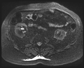 Adrenal cortical carcinoma (Radiopaedia 64017-72770 Axial DWI 75).jpg