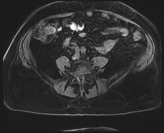 File:Adrenal cortical carcinoma (Radiopaedia 64017-72770 Axial T1 C+ fat sat 56).jpg