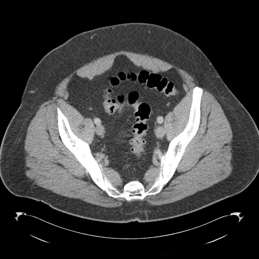 File:Adrenal cyst (Radiopaedia 45625-49776 Axial C+ portal venous phase 81).png