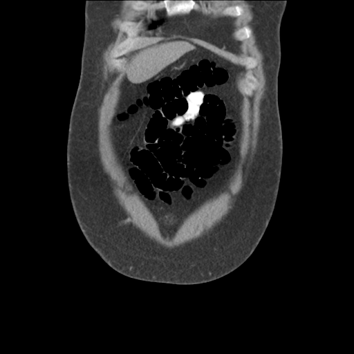 Adrenal cyst (Radiopaedia 45625-49776 Coronal C+ portal venous phase 14).png