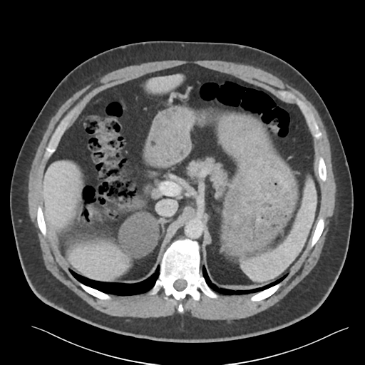 File:Adrenal cyst (Radiopaedia 45625-49777 Axial C+ portal venous phase 32).png