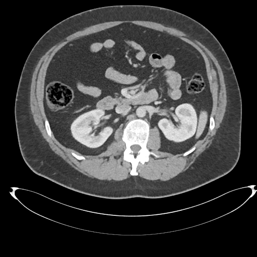 File:Adrenal cyst (Radiopaedia 45625-49778 AXIAL THICK 60 sec 36).png