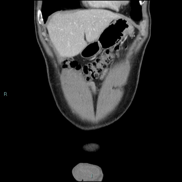 Adrenal cystic lymphangioma (Radiopaedia 83161-97534 Coronal C+ portal venous phase 15).jpg