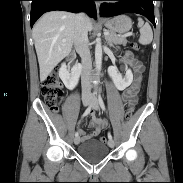 Adrenal cystic lymphangioma (Radiopaedia 83161-97534 Coronal C+ portal venous phase 37).jpg
