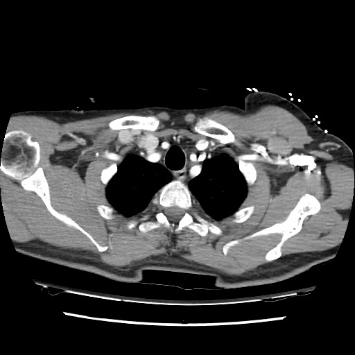Adrenal gland trauma (Radiopaedia 81351-95078 Axial Dual bolus trauma C+ 15).jpg
