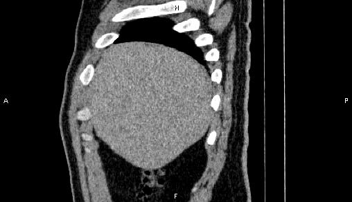 Adrenal myelolipoma (Radiopaedia 84321-99619 Sagittal non-contrast 14).jpg