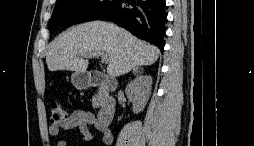 Adrenal myelolipoma (Radiopaedia 84321-99619 Sagittal non-contrast 40).jpg
