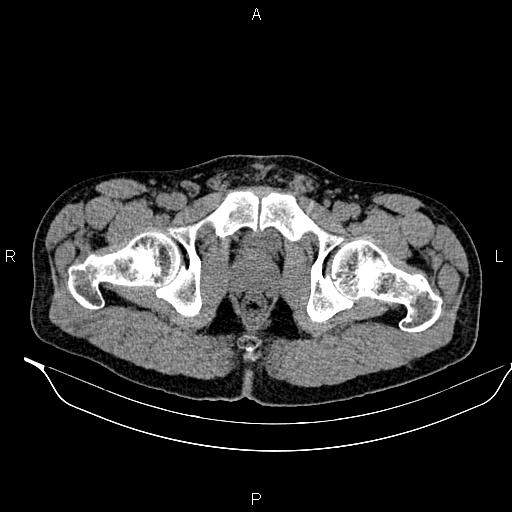 Adrenal myelolipoma (Radiopaedia 87794-104246 Axial non-contrast 107).jpg