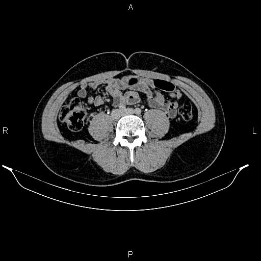 Adrenal myelolipoma (Radiopaedia 87794-104246 Axial renal excretory phase 63).jpg