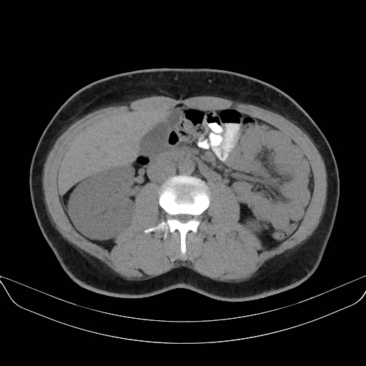 Adrenal myelolipoma - bilateral (Radiopaedia 74805-85810 Axial non-contrast 37).jpg