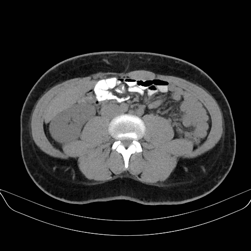 File:Adrenal myelolipoma - bilateral (Radiopaedia 74805-85810 Axial non-contrast 45).jpg