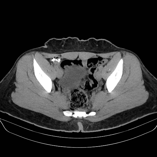 Adrenal myelolipoma - bilateral (Radiopaedia 74805-85810 Axial non-contrast 71).jpg