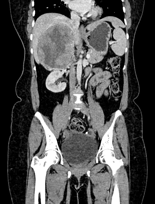 Adrenocortical carcinoma (Radiopaedia 87281-103569 Coronal C+ portal venous phase 51).jpg