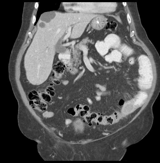 Adult ileal intussusception with secondary obstruction (Radiopaedia 30395-31051 Coronal C+ portal venous phase 23).jpg