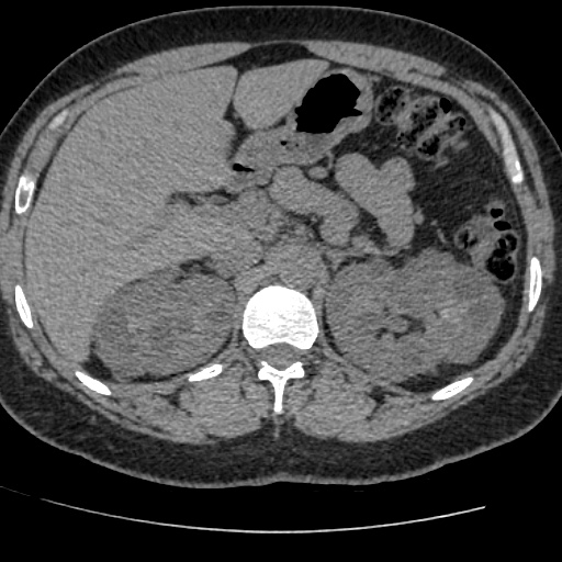 Adult polycystic kidney disease (Radiopaedia 59075-66368 Axial non-contrast 16).jpg