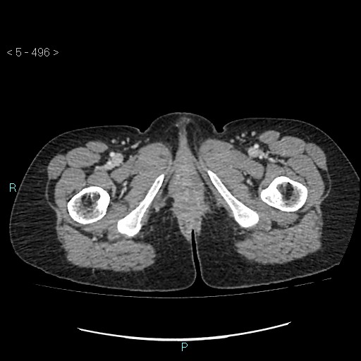 Adult transient intestinal intussusception (Radiopaedia 34853-36310 Axial C+ portal venous phase 137).jpg