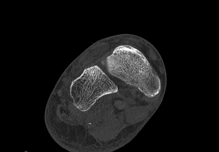 Advanced osteomyelitis due to open metatarsal fracture (Radiopaedia 83891-99095 Axial bone window 19).jpg