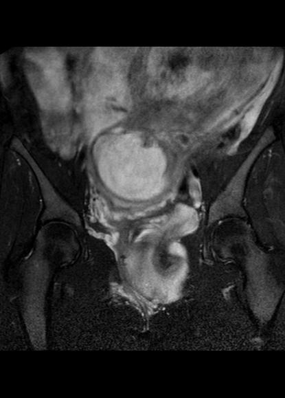 File:Aggressive angiomyxoma of the pelvis and perineum (Radiopaedia 59162-66479 Coronal T2 fat sat 13).jpg