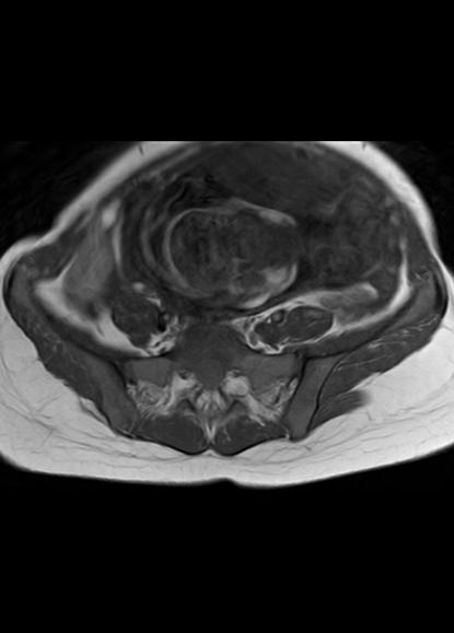 File:Aggressive angiomyxoma of the pelvis and perineum (Radiopaedia 59162-66479 T1 24).jpg