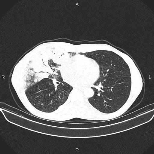Air bronchogram in pneumonia (Radiopaedia 85719-101512 Axial lung window 39).jpg