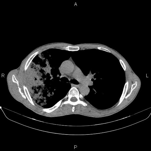 Air bronchogram in pneumonia (Radiopaedia 85719-101512 Axial non-contrast 28).jpg