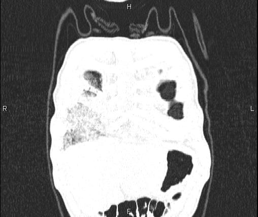 Air bronchogram in pneumonia (Radiopaedia 85719-101512 Coronal lung window 5).jpg