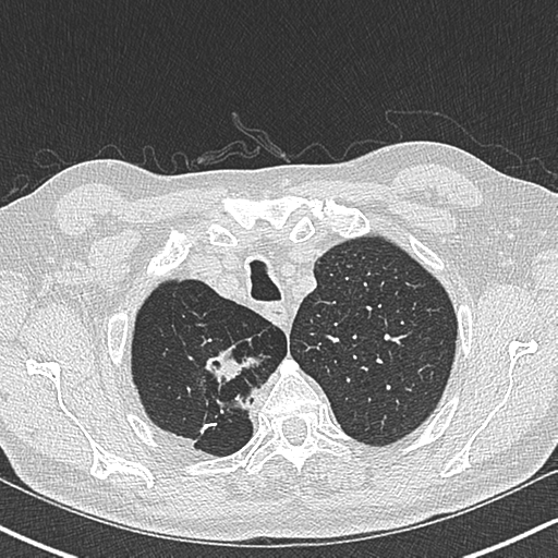 Allergic bronchopulmonary aspergillosis (Radiopaedia 44760-48571 Axial lung window 11).png