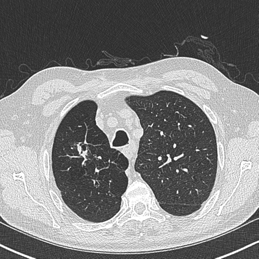 Allergic bronchopulmonary aspergillosis (Radiopaedia 44760-48571 Axial lung window 16).png