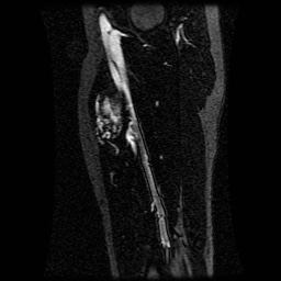 Alveolar soft part sarcoma (Radiopaedia 64501-73678 D 55).jpg
