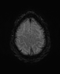 File:Alzheimer's disease- with Gerstmann syndrome and dressing apraxia (Radiopaedia 54882-61150 Axial SWI 31).png