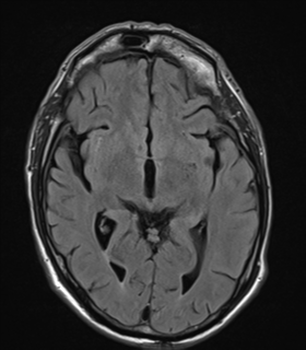 File:Alzheimer's disease- with apraxia (Radiopaedia 54763-61011 Axial FLAIR 13).png