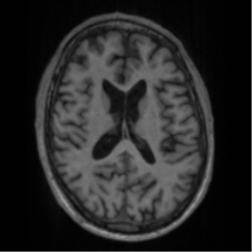 Alzheimer's disease- with apraxia (Radiopaedia 54763-61011 Axial T1 44).png