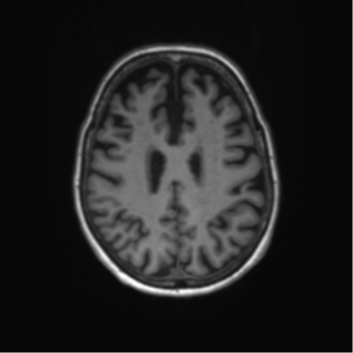 File:Alzheimer's disease (Radiopaedia 42658-45802 Axial T1 54).png