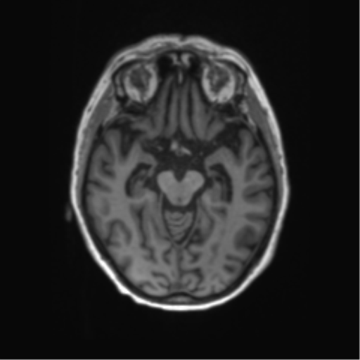 File:Alzheimer's disease (Radiopaedia 42658-45802 Axial T1 94).png